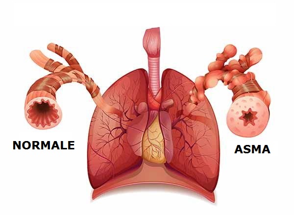asma