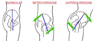 retroversione pelvica